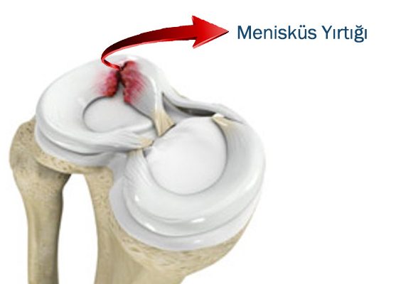 Menisküs Yaralanmaları Nedir