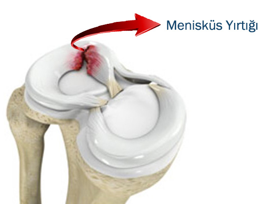 Menisküs Yaralanmaları Nedir