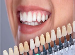 Porselen Diş Yapımında Güvenin Adresi Porselen Diş Yapımında Güvenin Adresi